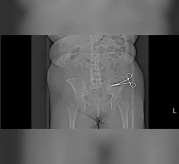 Imagem ilustrativa da imagem Mulher descobre tesoura no abdômen 7 meses após cirurgia