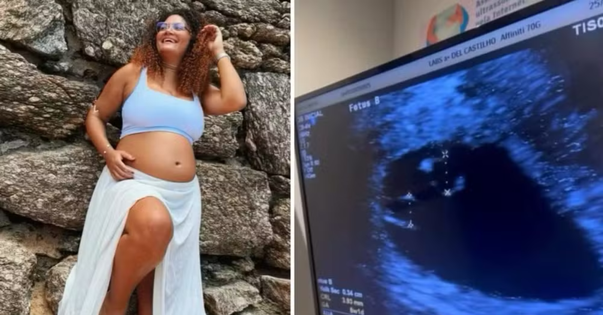 Superfetação é um fenômeno extremamente raro associado à ocorrência de uma nova concepção durante uma gravidez; Thaís deu à luz três meninas após descobrir que esperava inicialmente gêmeos.