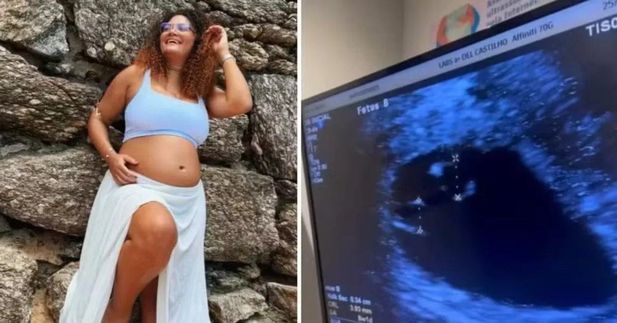 Superfetação é um fenômeno extremamente raro associado à ocorrência de uma nova concepção durante uma gravidez; Thaís deu à luz três meninas após descobrir que esperava inicialmente gêmeos.