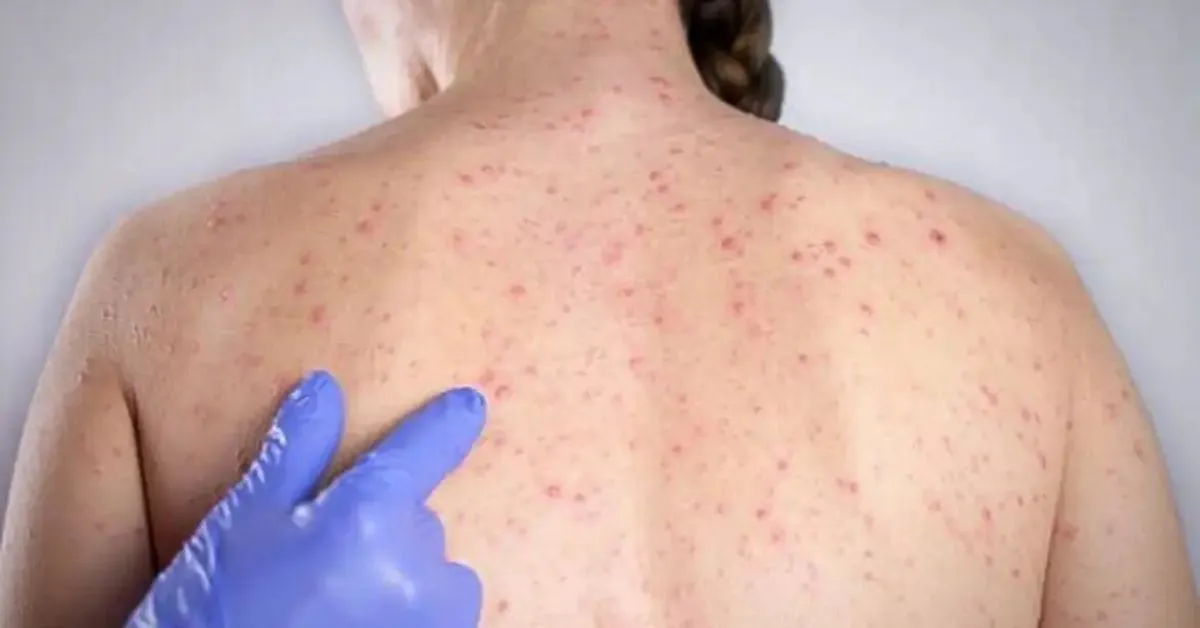 O sarampo é doença viral infecciosa aguda altamente contagiosa e potencialmente grave, podendo deixar sequelas ou levar à morte.