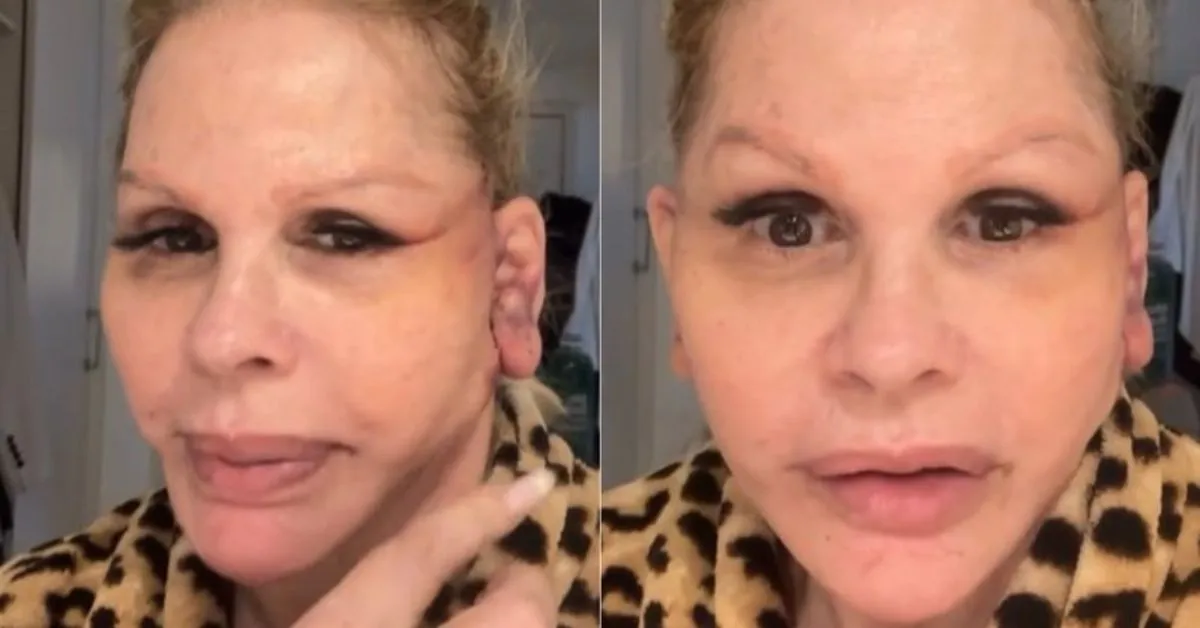 Monique Evans compartilhou detalhes da recuperação após realizar um minilifting facial