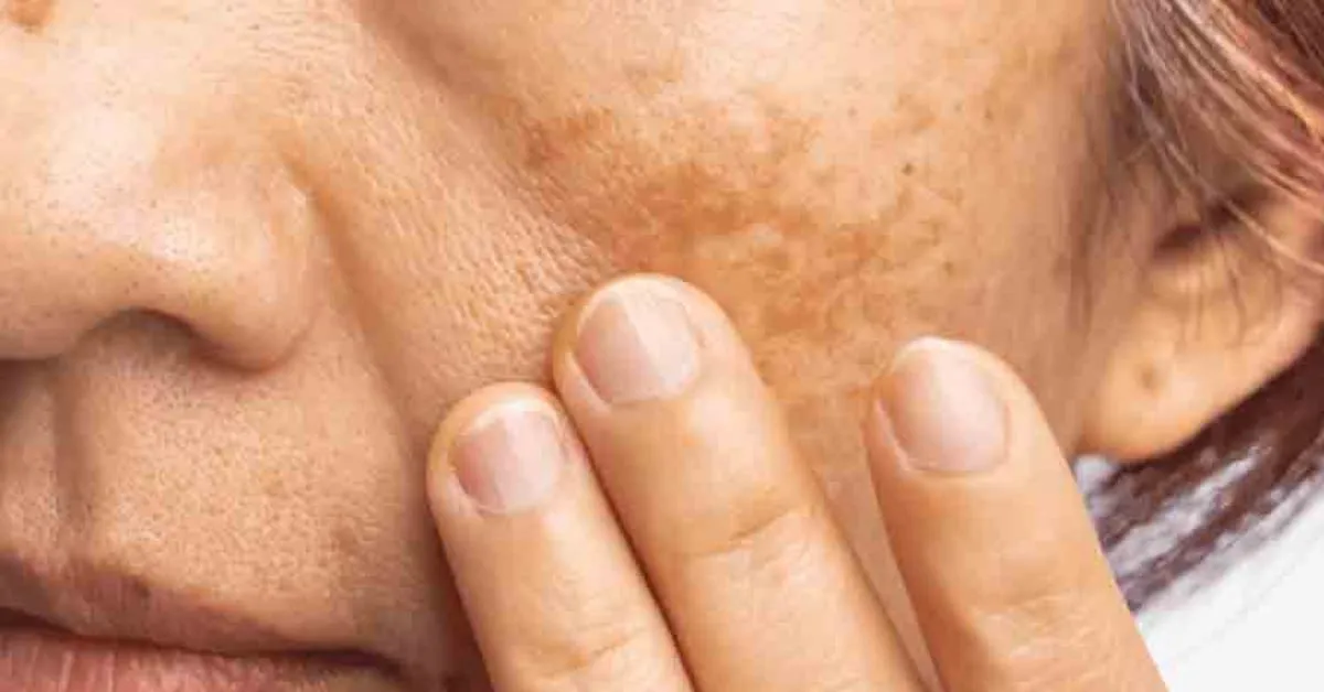 De acordo com a Sociedade Brasileira de Dermatologia, estima-se que cerca de 35% das mulheres brasileiras em idade fértil apresentem algum grau de melasma.