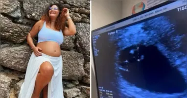 Superfetação é um fenômeno extremamente raro associado à ocorrência de uma nova concepção durante uma gravidez; Thaís deu à luz três meninas após descobrir que esperava inicialmente gêmeos.