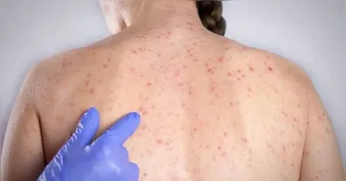 O sarampo é doença viral infecciosa aguda altamente contagiosa e potencialmente grave, podendo deixar sequelas ou levar à morte.