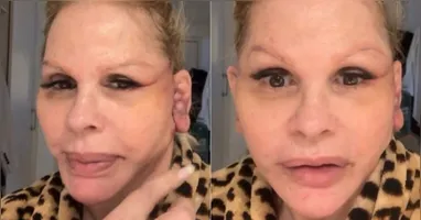 Monique Evans compartilhou detalhes da recuperação após realizar um minilifting facial