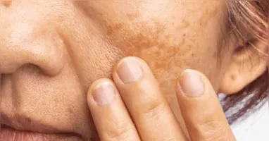 De acordo com a Sociedade Brasileira de Dermatologia, estima-se que cerca de 35% das mulheres brasileiras em idade fértil apresentem algum grau de melasma.