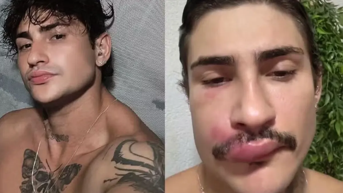 Imagem ilustrativa da notícia Influenciador é internado após espremer espinha na face