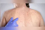 O sarampo é doença viral infecciosa aguda altamente contagiosa e potencialmente grave, podendo deixar sequelas ou levar à morte.