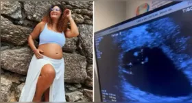 Superfetação é um fenômeno extremamente raro associado à ocorrência de uma nova concepção durante uma gravidez; Thaís deu à luz três meninas após descobrir que esperava inicialmente gêmeos.