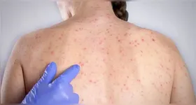 O sarampo é doença viral infecciosa aguda altamente contagiosa e potencialmente grave, podendo deixar sequelas ou levar à morte.