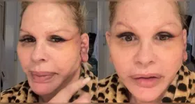 Monique Evans compartilhou detalhes da recuperação após realizar um minilifting facial