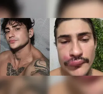 Imagem ilustrativa da imagem Influenciador é internado após espremer espinha na face