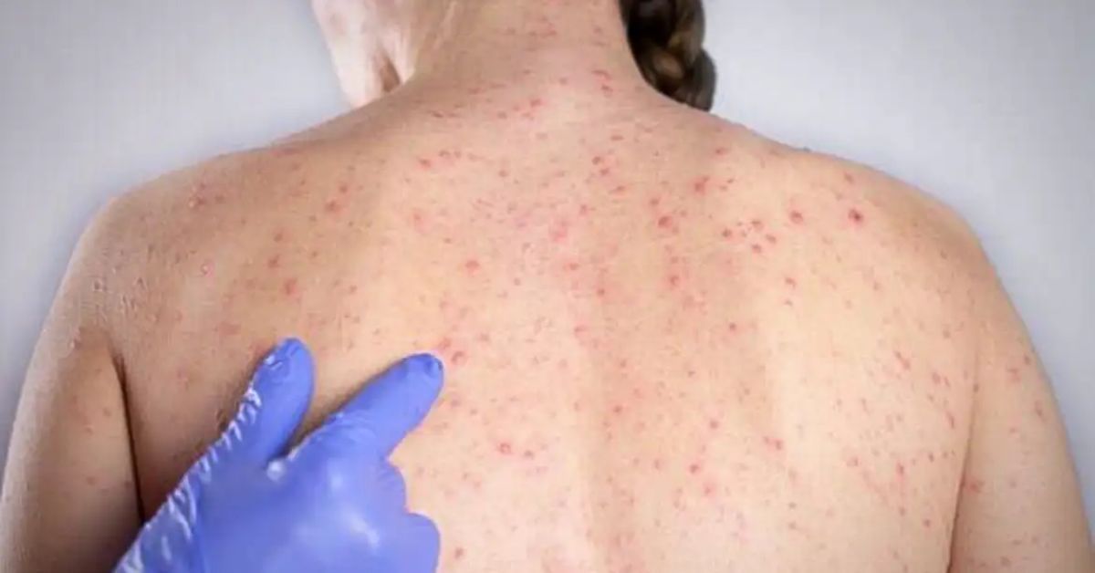 O sarampo é doença viral infecciosa aguda altamente contagiosa e potencialmente grave, podendo deixar sequelas ou levar à morte.