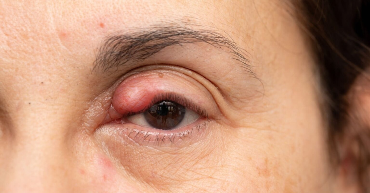 Entenda a diferença entre terçol e celulite ocular e quando buscar atendimento