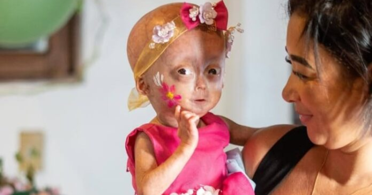 Elis Lima Carneiro, uma das gêmeas diagnosticadas com a rara síndrome de Hutchinson-Gilford, conhecida como progéria, morreu aos 5 anos.