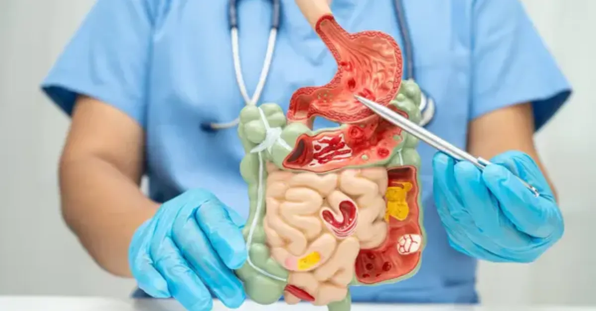 Câncer de intestino pode ser prevenido com hábitos saudáveis e rastreamento adequado. A colonoscopia ajuda a identificar e retirar pólipos que podem evoluir para tumores malignos, favorecendo o diagnóstico precoce e a redução dos riscos.