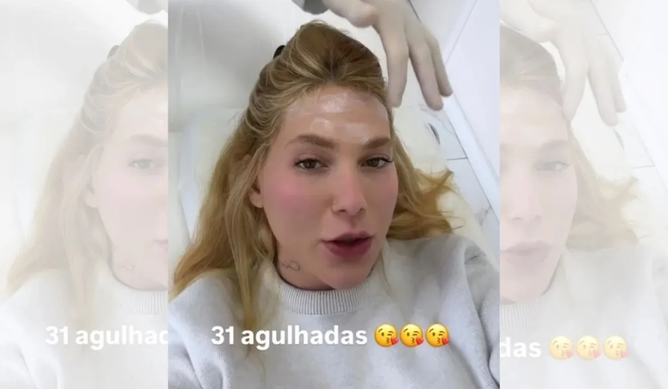 Virginia Fonseca revelou que retomou o tratamento com 31 aplicações de botox para controlar crises de enxaqueca.