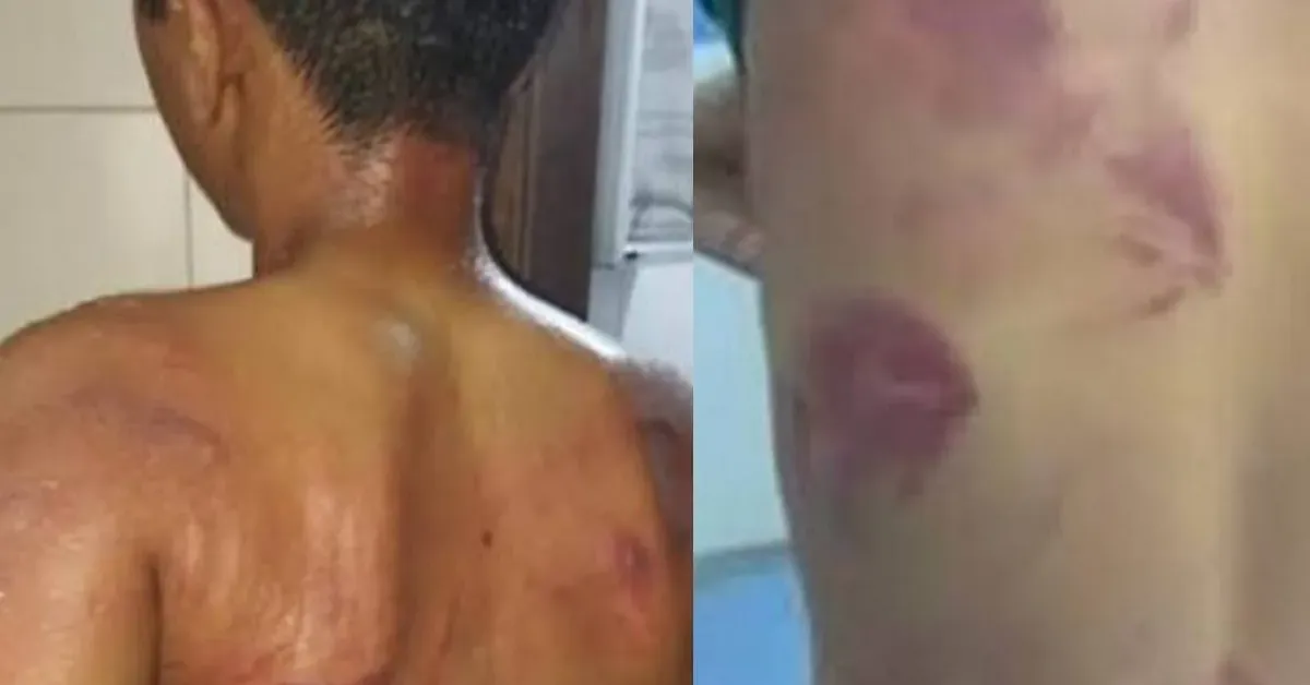 O adolescente ficou com marcas pelo corpo após ser agredido pelo próprio pai, em Pernambuco, por causa do uso de brincos