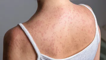 Pensilvânia confirma óbitos e São Paulo soma 36 infecções em 2026, acendendo alerta para a vacinação.
