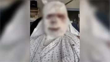 O empresário australiano Callum Forbes, que sofreu queimaduras de segundo grau no rosto e graves ferimentos pelo corpo após ser atacado enquanto dormia.