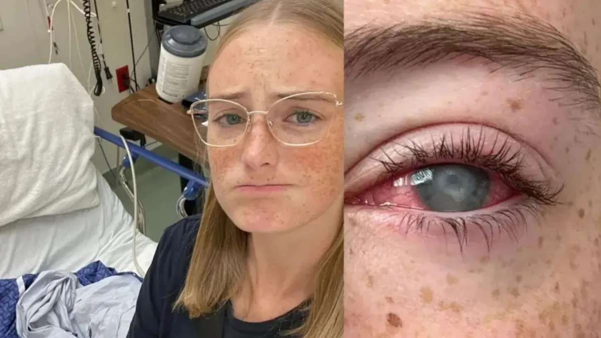 Imagem ilustrativa da notícia Jovem perde a visão após tomar banho usando lentes de contato