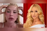 Virginia Fonseca aparece com o rosto vermelho e inchado após procedimento estético e tranquiliza seguidores sobre sua recuperação.