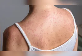Pensilvânia confirma óbitos e São Paulo soma 36 infecções em 2026, acendendo alerta para a vacinação.