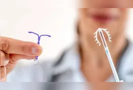 Nova regra da ANS começa em outubro e estabelece critérios para que pacientes tenham direito ao dispositivo hormonal e à implantação
