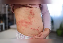 Vítimas eram moradoras não vacinadas do Condado de Lancaster. Queda na cobertura vacinal e avanço de surto preocupam autoridades de saúde.