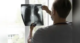 Para receber o tratamento, é necessário apresentar alta expressão da proteína c-Met nas células tumorais.