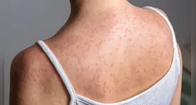 Pensilvânia confirma óbitos e São Paulo soma 36 infecções em 2026, acendendo alerta para a vacinação.