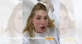 Virginia Fonseca revelou que retomou o tratamento com 31 aplicações de botox para controlar crises de enxaqueca.
