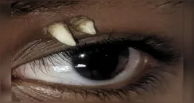 Adolescente na Índia desenvolveu um dente ectópico na órbita ocular; tomografia identificou um canino, posteriormente removido por cirurgia.