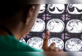 Apesar do avanço, a estratégia ainda está em fase de pesquisa e não pode ser considerada um tratamento comprovado para o Alzheimer.