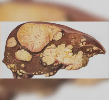 Imagem ilustrativa da imagem Gordura no fígado: 5 sintomas que podem surgir no estágio inicial