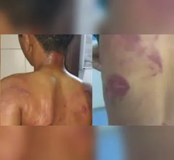 Imagem ilustrativa da imagem Pai é preso após espancar filho de 13 anos por usar brincos em Pernambuco