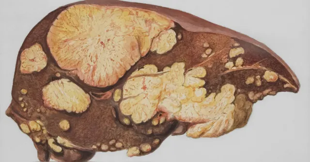 Imagem ilustrativa da notícia Gordura no fígado: 5 sintomas que podem surgir no estágio inicial
