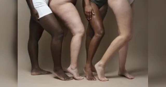 Imagem ilustrativa da notícia Gordura localizada ou lipedema? Veja 4 diferenças durante emagrecimento