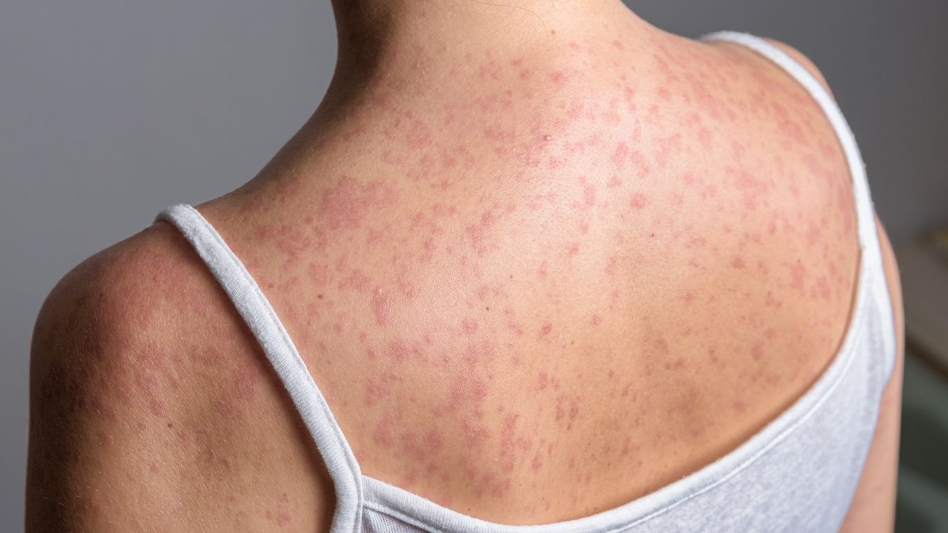 Pensilvânia confirma óbitos e São Paulo soma 36 infecções em 2026, acendendo alerta para a vacinação.