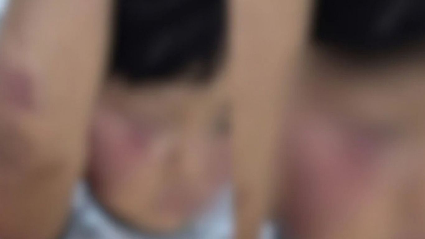 Família diz que menino voltou da instituição com machucados no rosto e no corpo; responsáveis pelo local apresentam outra versão