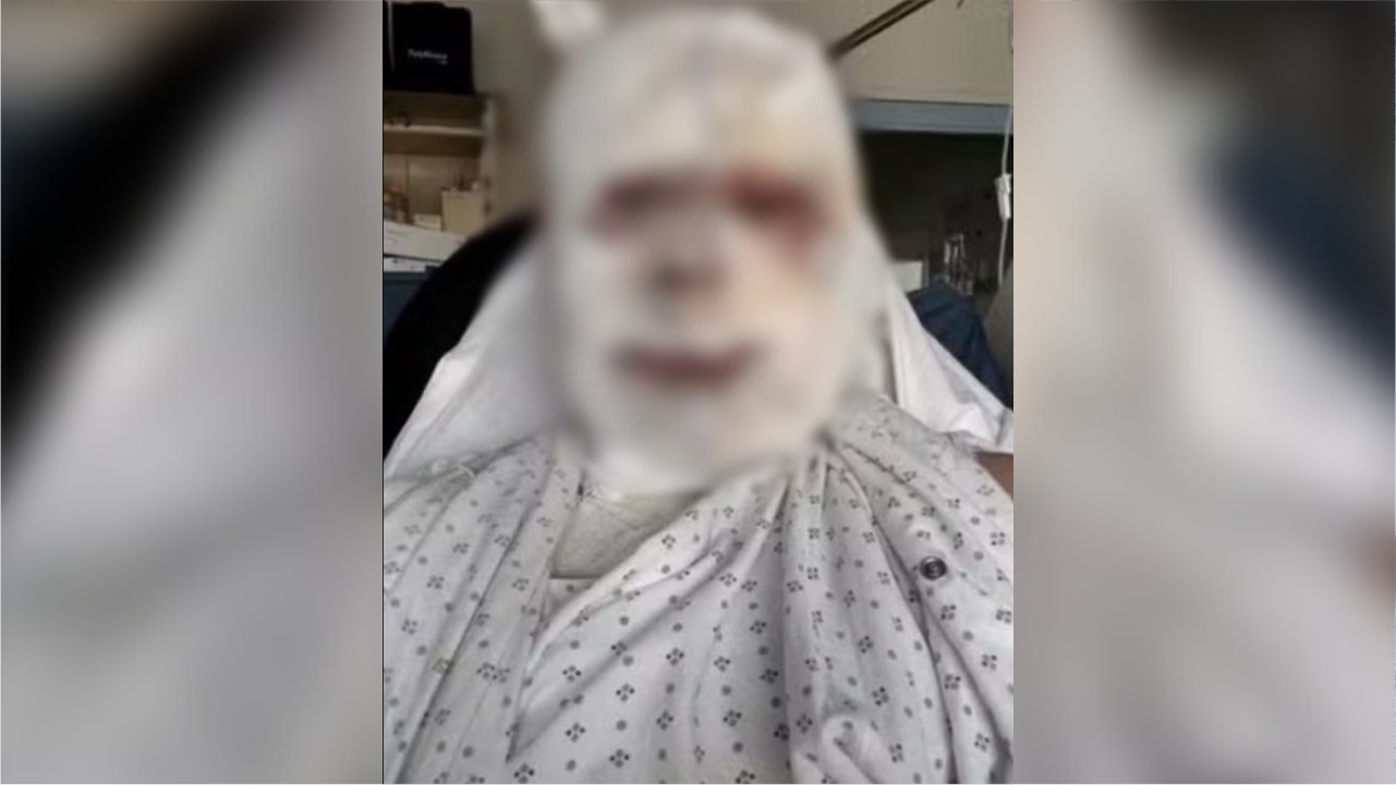 O empresário australiano Callum Forbes, que sofreu queimaduras de segundo grau no rosto e graves ferimentos pelo corpo após ser atacado enquanto dormia.