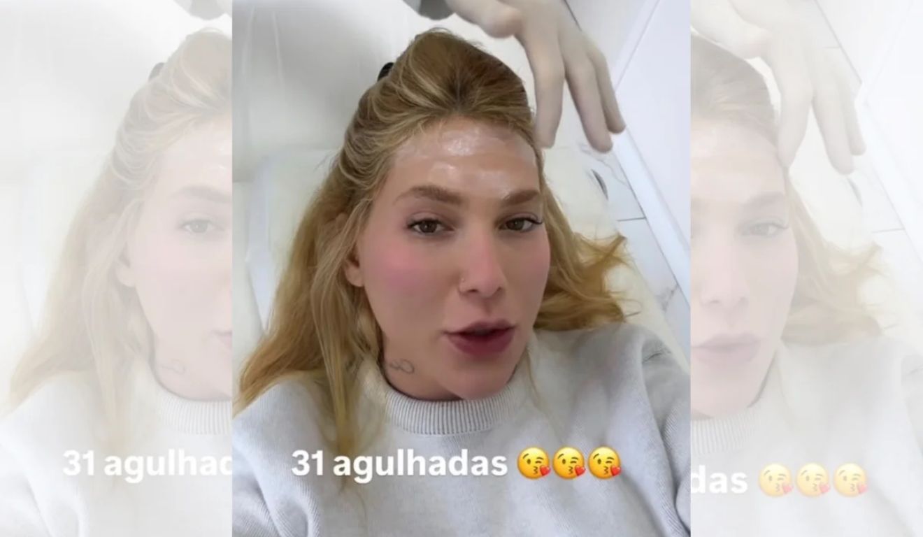 Virginia Fonseca revelou que retomou o tratamento com 31 aplicações de botox para controlar crises de enxaqueca.