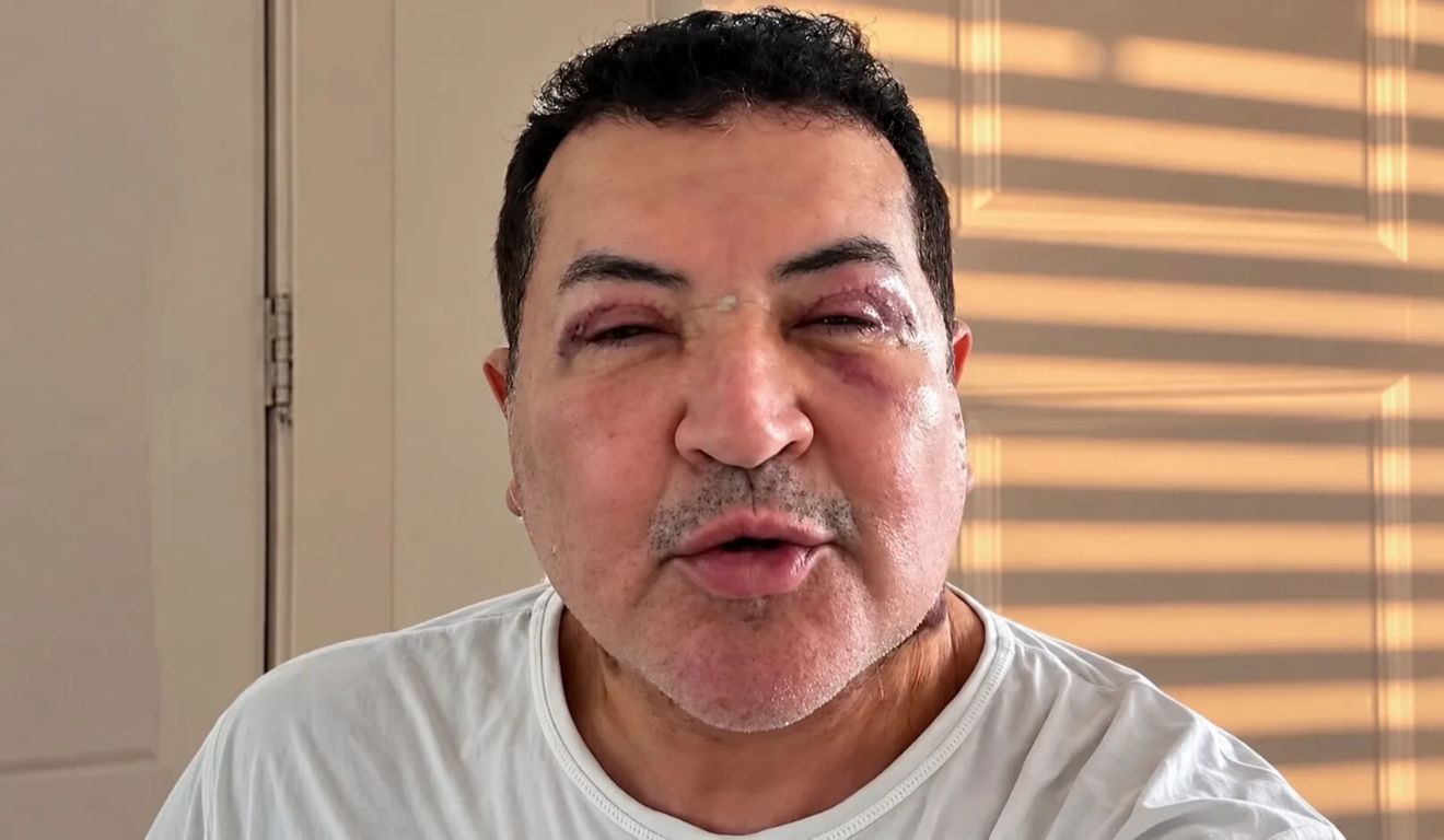 O artista afirmou que a aparência deve mudar ao longo dos próximos meses, até que o inchaço diminua completamente.
