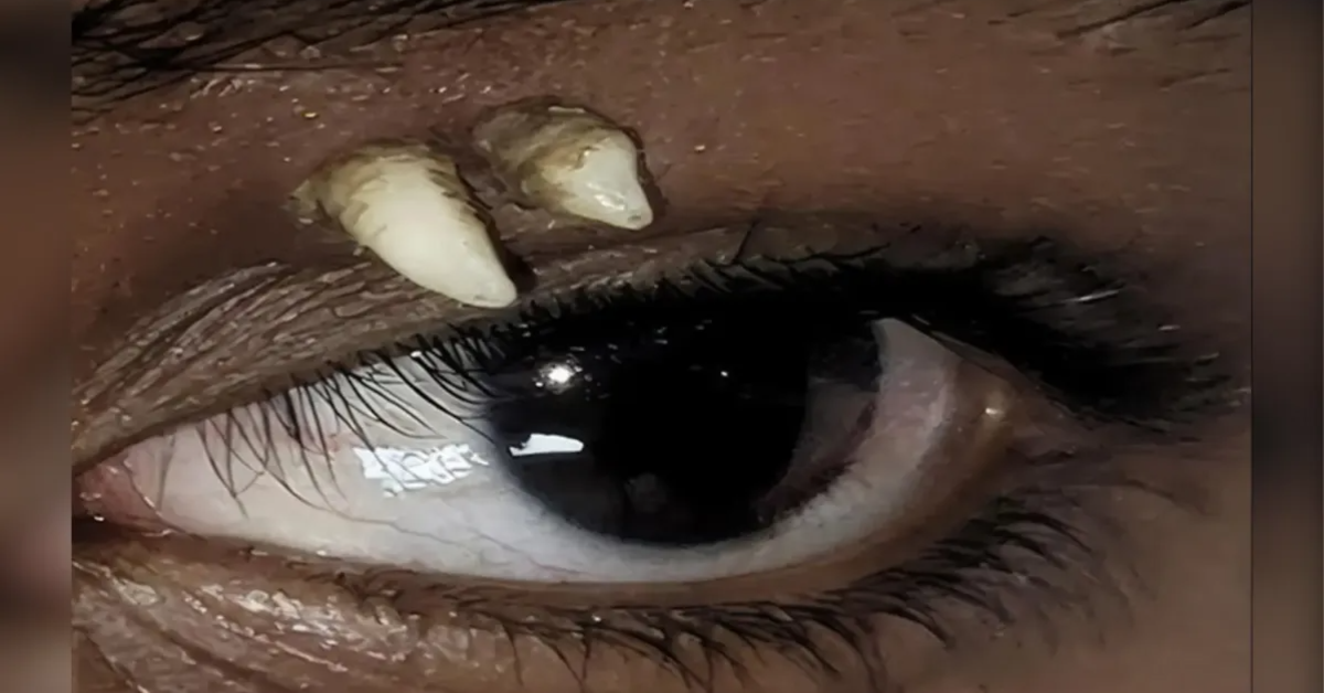 Adolescente na Índia desenvolveu um dente ectópico na órbita ocular; tomografia identificou um canino, posteriormente removido por cirurgia.