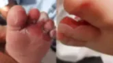 Bebê, de 1 ano, sofreu queimaduras de segundo grau no pé esquerdo.