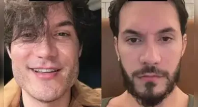Imagem ilustrativa da notícia: Desarmonização facial pode ser dolorosa, causar reação e flacidez