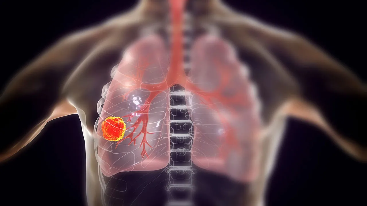 Imagem ilustrativa da notícia: Estudo mostra que metástase é mais frequente no pulmão