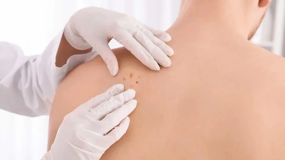 Imagem ilustrativa da notícia: Médico lista sinais para saber se uma pinta é câncer de pele