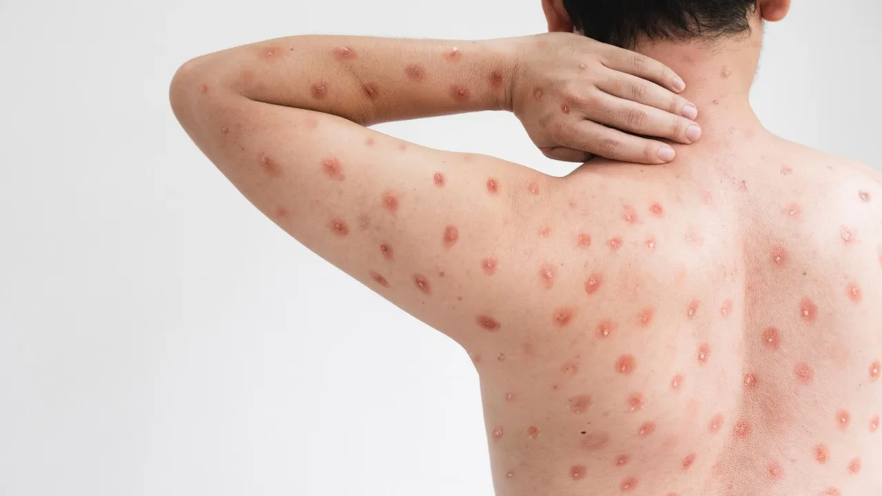 Imagem ilustrativa da notícia: Mpox: saiba o que é, como se transmite e como se proteger
