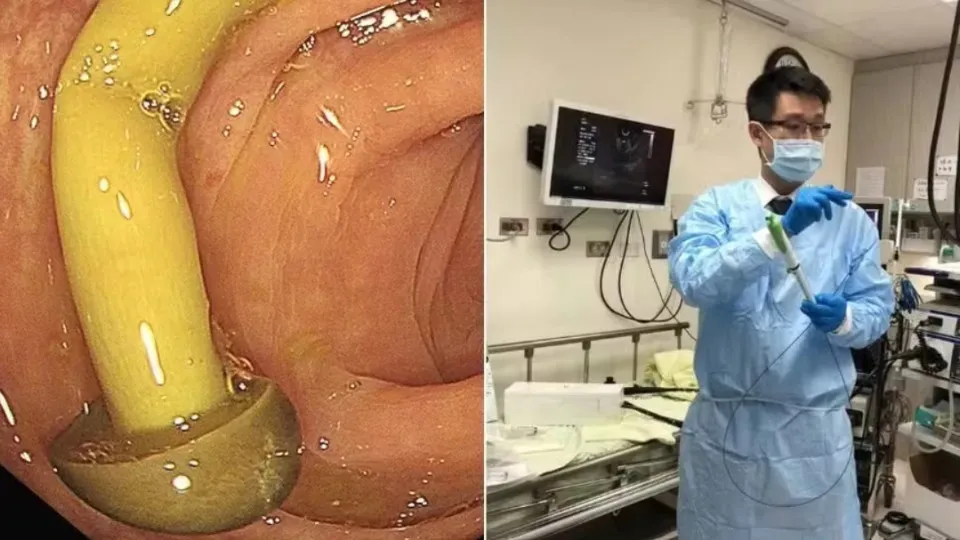 Imagem ilustrativa da notícia: Médico descobre cogumelo crescendo no intestino de paciente